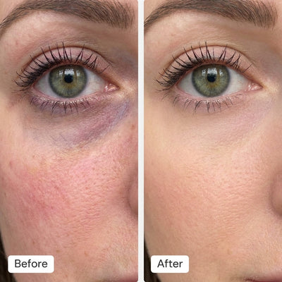RED LIGHT EYE LIFT