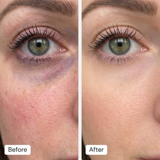 RED LIGHT EYE LIFT