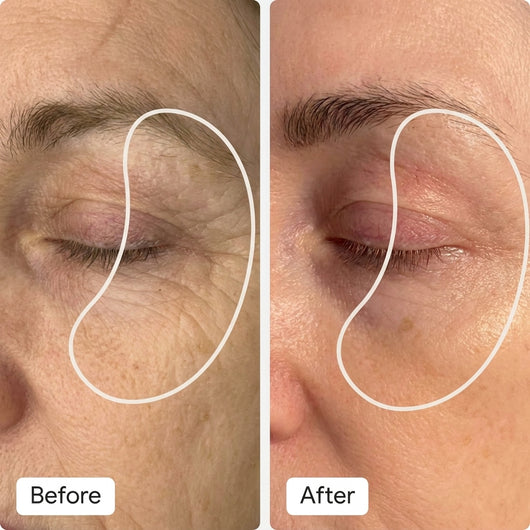 RED LIGHT EYE LIFT